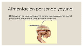 Alimentación por sonda yeyunal 
◦ Colocación de una sonda en la luz delyeyuno proximal, conel 
propósito fundamental de suministrar nutrición 
 