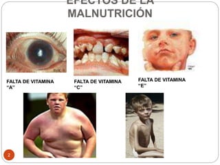 EFECTOS DE LA
MALNUTRICIÓN
2
FALTA DE VITAMINA
“A”
FALTA DE VITAMINA
“C”
FALTA DE VITAMINA
“E”
