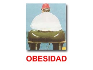 OBESIDAD 