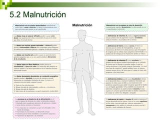 5.2 Malnutrición 