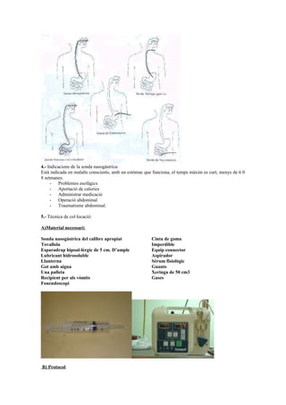 4.- Indicacions de la sonda nasogàstrica: 
Està indicada en malalts conscients, amb un estómac que funciona, el temps màxim es curt, menys de 6 0 
8 setmanes. 
- Problemes esofàgics 
- Aportació de calories 
- Administrar medicació 
- Operació abdominal 
- Traumatisme abdominal. 
5.- Tècnica de col·locació: 
A)Material necessari: 
Sonda nasogàstrica del calibre apropiat 
Tovallola 
Esparadrap hipoal-lèrgic de 5 cm. D’ample 
Lubricant hidrosoluble 
Llanterna 
Got amb aigua 
Una palleta 
Recipient per als vòmits 
Fonendoscopi 
Cinta de goma 
Imperdible 
Equip connector 
Aspirador 
Sèrum fisiològic 
Guants 
Xeringa de 50 cm3 
Gases 
B) Protocol: 
 