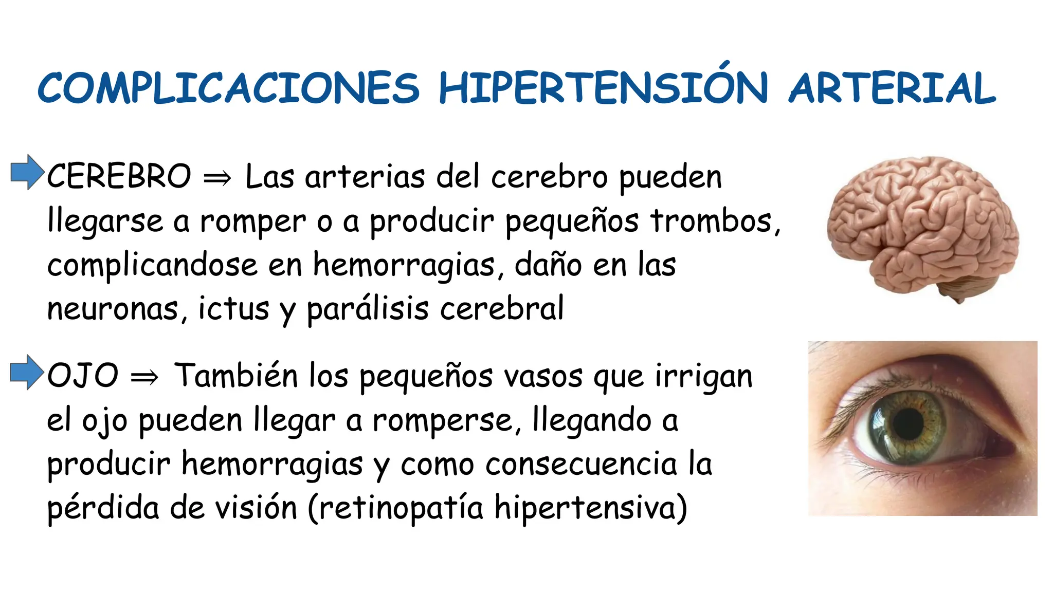 COMPLICACIONES HIPERTENSIÓN ARTERIAL
CEREBRO ⇒ Las arterias del cerebro pueden
llegarse a romper o a producir pequeños trombos,
complicandose en hemorragias, daño en las
neuronas, ictus y parálisis cerebral
OJO ⇒ También los pequeños vasos que irrigan
el ojo pueden llegar a romperse, llegando a
producir hemorragias y como consecuencia la
pérdida de visión (retinopatía hipertensiva)
 