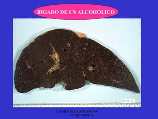HIGADO DE UN ALCOHÓLICO




     CARMEN GLORIA FRANCO M.
           NUTRICIONISTA
 
