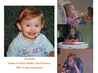 18 months
Failure to Thrive, Reflux, Speech delays,
100% G-tube dependence
 