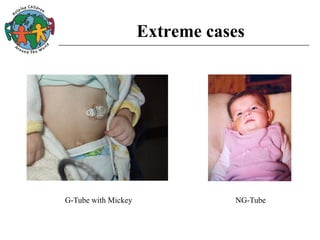 Extreme cases
NG-TubeG-Tube with Mickey
 