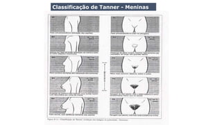 Classificação de Tanner - Meninas
 