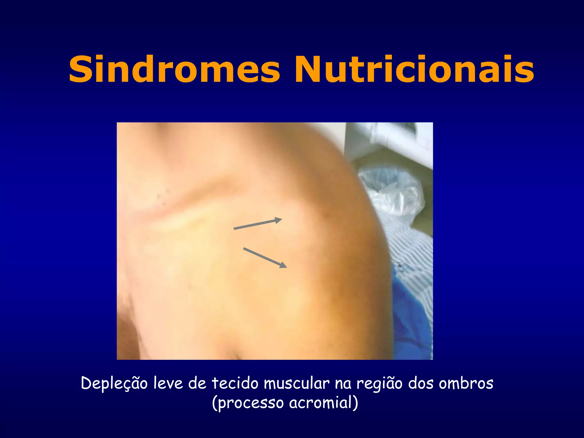 Depleção leve de tecido muscular na região dos ombros
(processo acromial)
Sindromes Nutricionais
 