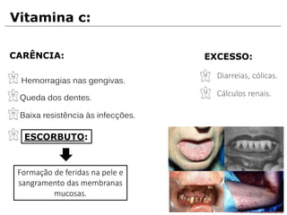Vitamina c:
CARÊNCIA:
Hemorragias nas gengivas.
Queda dos dentes.
Baixa resistência às infecções.
ESCORBUTO:
EXCESSO:
Diarreias, cólicas.
Cálculos renais.
Formação de feridas na pele e
sangramento das membranas
mucosas.
 