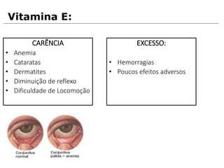 CARÊNCIA
• Anemia
• Cataratas
• Dermatites
• Diminuição de reflexo
• Dificuldade de Locomoção
Vitamina E:
EXCESSO:
• Hemorragias
• Poucos efeitos adversos
 
