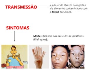 TRANSMISSÃO
é adquirido através da ingestão
de alimentos contaminados com
a toxina botulínica.
SINTOMAS
Morte = falência dos músculos respiratórios
(Diafragma);
 