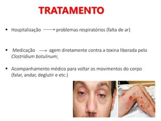 TRATAMENTO
 Hospitalização problemas respiratórios (falta de ar)
 Medicação agem diretamente contra a toxina liberada pelo
Clostridium botulinum;
 Acompanhamento médico para voltar os movimentos do corpo
(falar, andar, deglutir e etc.)
 
