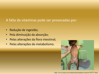 A falta de vitaminas pode ser provocadas por:
• Redução de ingestão;
• Pela diminuição da absorção;
• Pelas alterações da flora intestinal;
• Pelas alterações do metabolismo.
http://www.esmas.com/salud/enfermedades/cronicas/520757.html
 