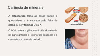 Carência de minerais
• A osteoporose torna os ossos frágeis e
quebradiços e é causada pela falta de
cálcio ou de vitaminas D ou K.
• O bócio afeta a glândula tiroide (localizada
na parte anterior e inferior do pescoço) e é
causado por carência de iodo.
 