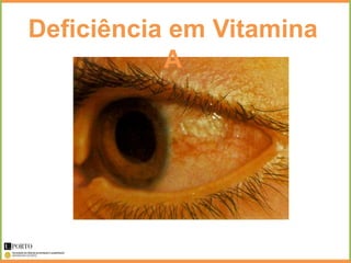 Deficiência em Vitamina
           A
 