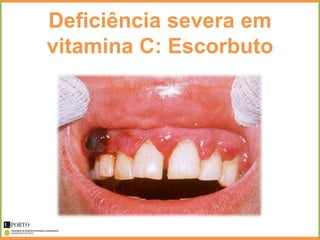 Deficiência severa em
vitamina C: Escorbuto
 