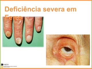 Deficiência severa em
Ferro
 