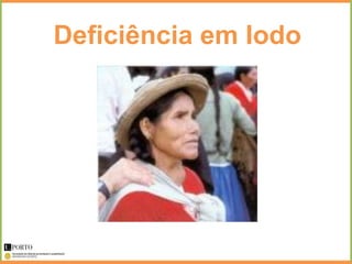 Deficiência em Iodo
 