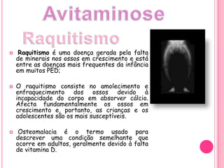AvitaminoseRaquitismoRaquitismo é uma doença gerada pela falta de minerais nos ossos em crescimento e está entre as doenças mais frequentes da infância em muitos PED; O raquitismo consiste no amolecimento e enfraquecimento dos ossos devido à incapacidade do corpo em absorver cálcio. Afecta fundamentalmente os ossos em crescimento e, portanto, as crianças e os adolescentes são os mais susceptíveis.Osteomalacia é o termo usado para descrever uma condição semelhante que ocorre em adultos, geralmente devido à falta de vitamina D.