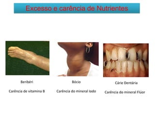 Excesso e carência de Nutrientes
Beribéri
Carência de vitamina B
Bócio
Carência do mineral Iodo
Cárie Dentária
Carência do mineral Flúor
 
