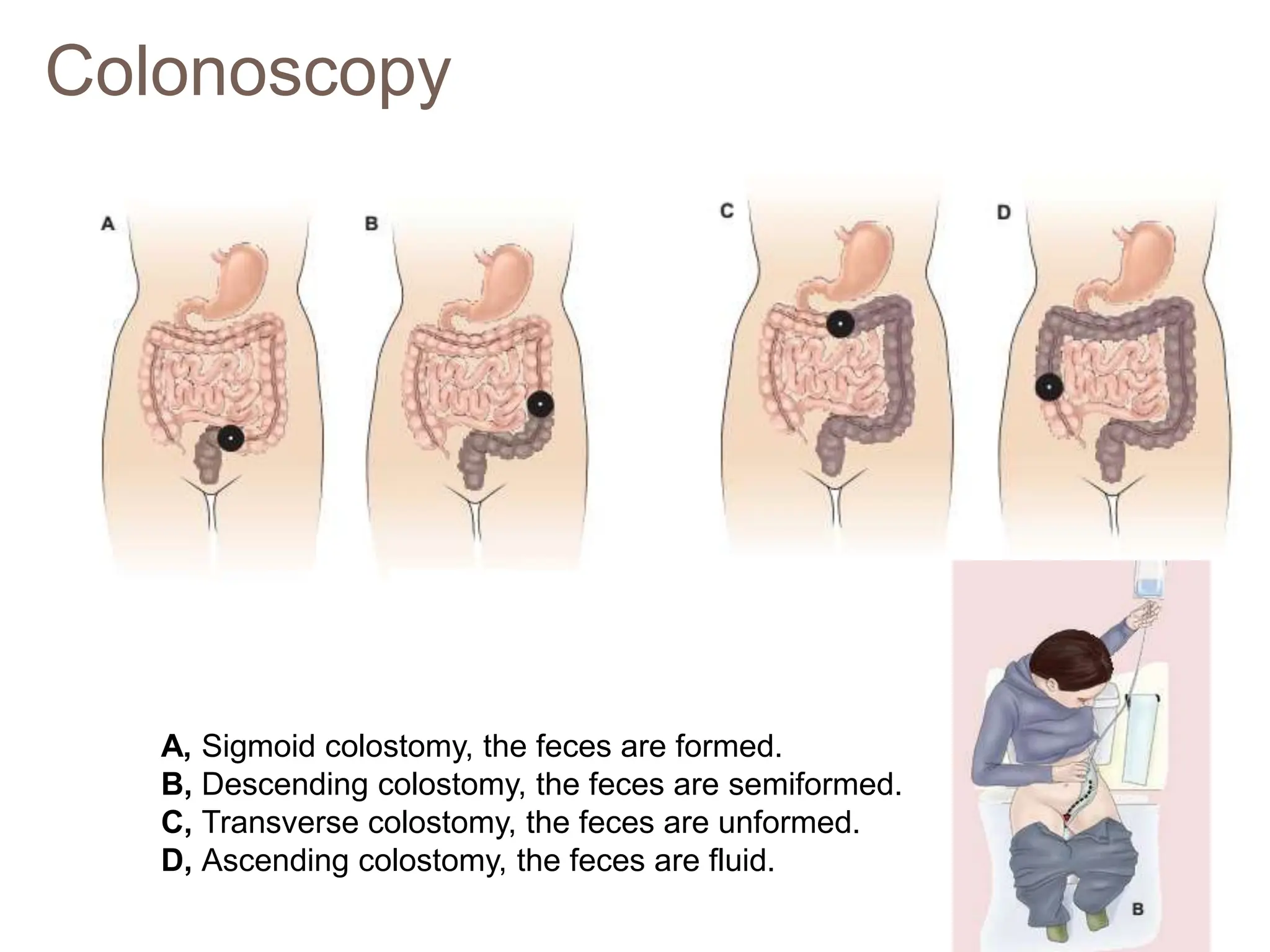 Colonoscopy
A, Sigmoid colostomy, the feces are formed.
B, Descending colostomy, the feces are semiformed.
C, Transverse colostomy, the feces are unformed.
D, Ascending colostomy, the feces are fluid.
 