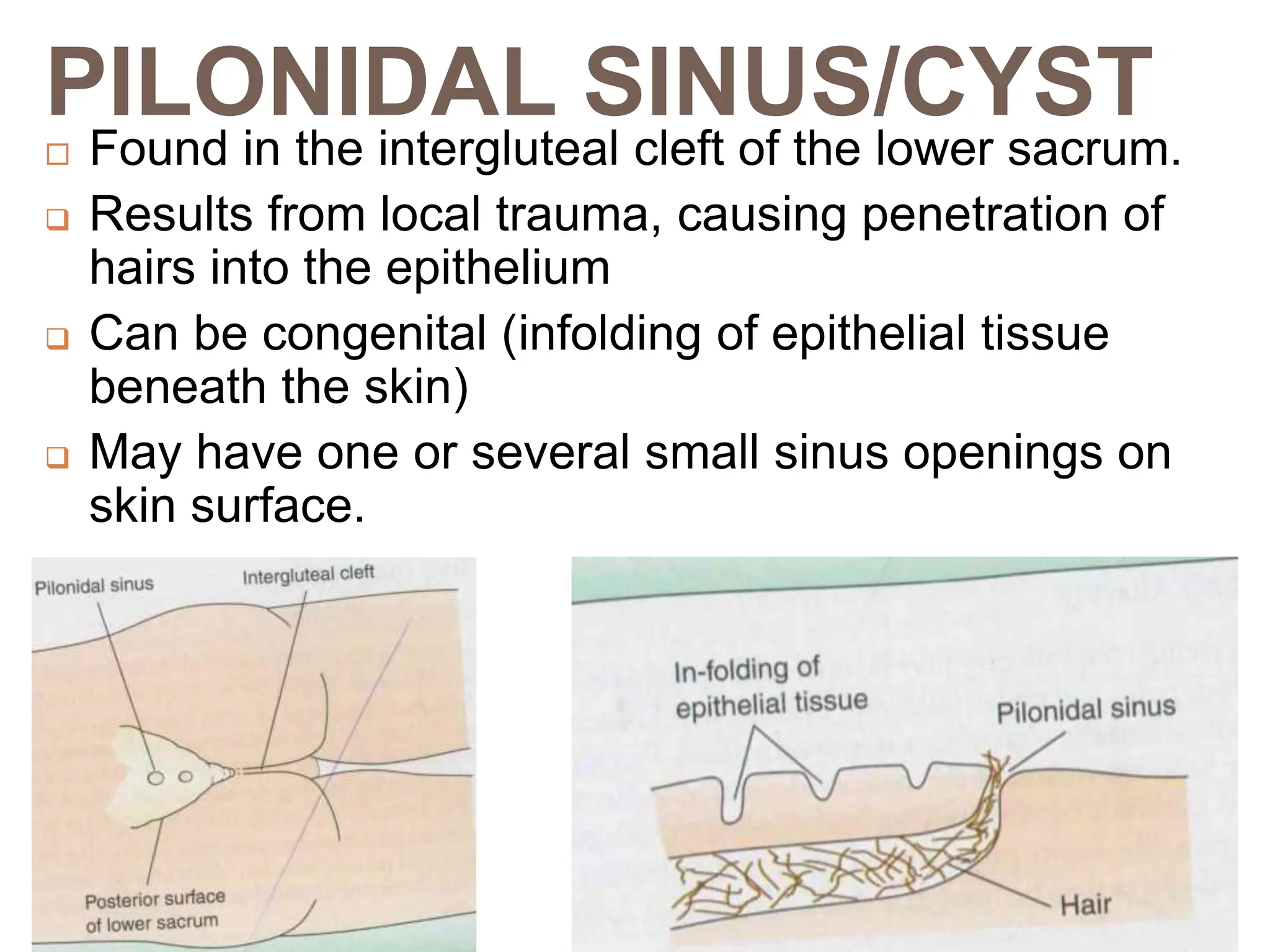PILONIDAL SINUS/CYST
 Found in the intergluteal cleft of the lower sacrum.
 Results from local trauma, causing penetration of
hairs into the epithelium
 Can be congenital (infolding of epithelial tissue
beneath the skin)
 May have one or several small sinus openings on
skin surface.
 