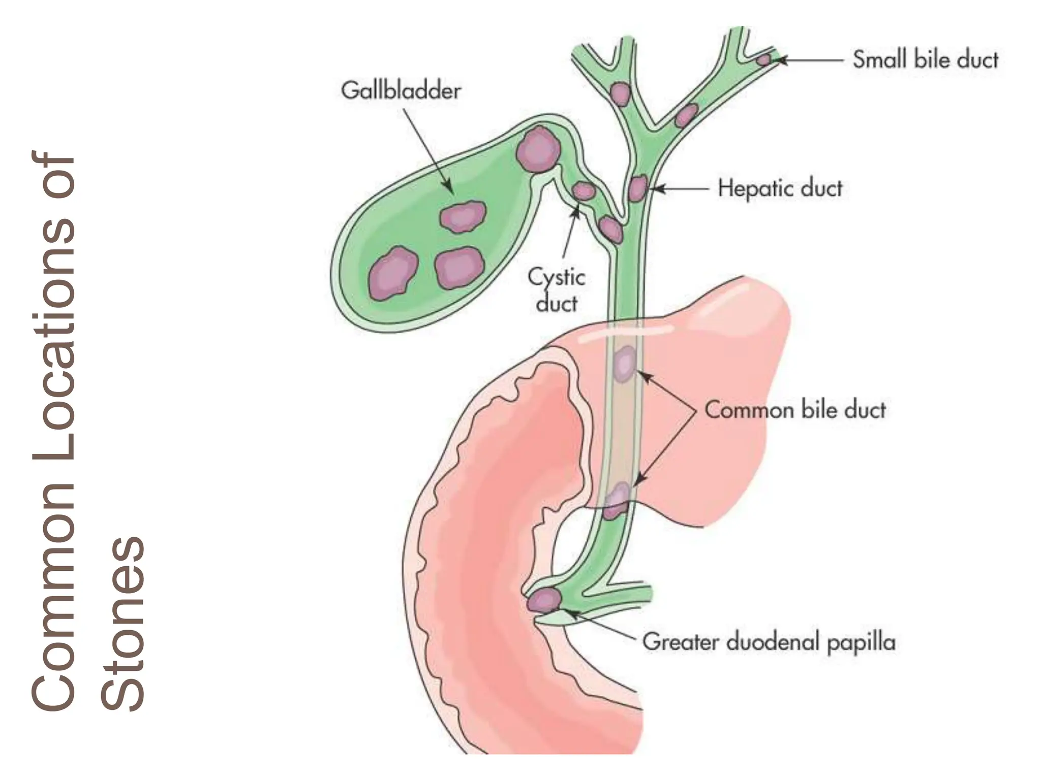 Common
Locations
of
Stones
 