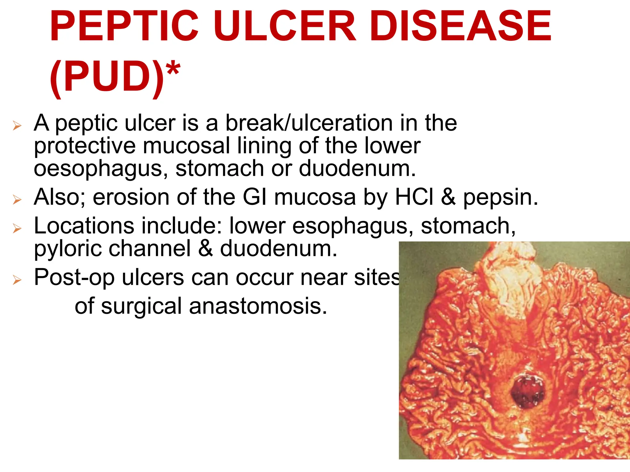 PEPTIC ULCER DISEASE
(PUD)*
 A peptic ulcer is a break/ulceration in the
protective mucosal lining of the lower
oesophagus, stomach or duodenum.
 Also; erosion of the GI mucosa by HCl & pepsin.
 Locations include: lower esophagus, stomach,
pyloric channel & duodenum.
 Post-op ulcers can occur near sites
of surgical anastomosis.
 
