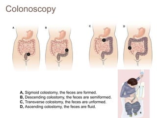 Colonoscopy
A, Sigmoid colostomy, the feces are formed.
B, Descending colostomy, the feces are semiformed.
C, Transverse colostomy, the feces are unformed.
D, Ascending colostomy, the feces are fluid.
 