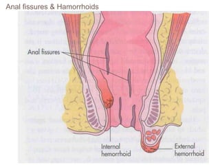 Anal fissures & Hamorrhoids
 