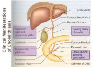 Clinical
Manifestations
of
Cholelithiasis
 