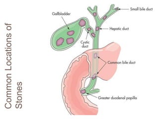 Common
Locations
of
Stones
 