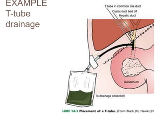 EXAMPLE
T-tube
drainage
 