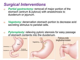 Surgical Interventions
a) Partial gastrectomy: removal of major portion of the
stomach (antrum & pylorus) with anastomosis to
duodenum or jejunum.
b) Vagotomy: denervation stomach portion to decrease acid
secreting stimulus to parietal cells.
c) Pyloroplasty: relieving pyloric stenosis for easy passage
of stomach contents into the duodenum.
 