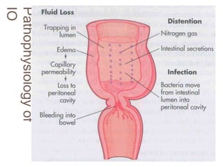 Pathophysiology
of
IO
 
