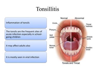 Tonsillitis
Inflammation of tonsils
The tonsils are the frequent sites of
acute infection especially in school-
going children
It may affect adults also
It is mostly seen in viral infection
 