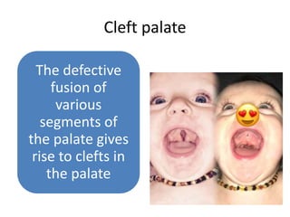 Cleft palate
The defective
fusion of
various
segments of
the palate gives
rise to clefts in
the palate
 