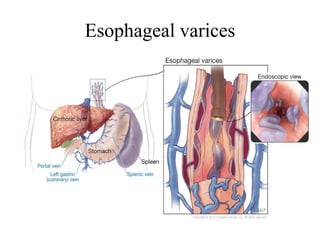 Esophageal varices
 
