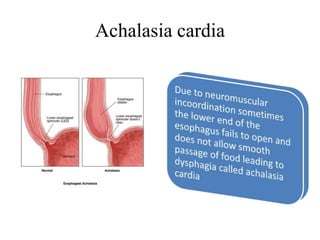 Achalasia cardia
 