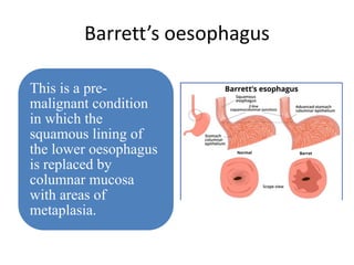 Barrett’s oesophagus
This is a pre-
malignant condition
in which the
squamous lining of
the lower oesophagus
is replaced by
columnar mucosa
with areas of
metaplasia.
 