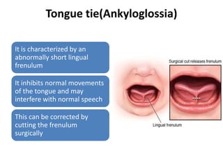 Tongue tie(Ankyloglossia)
It is characterized by an
abnormally short lingual
frenulum
It inhibits normal movements
of the tongue and may
interfere with normal speech
This can be corrected by
cutting the frenulum
surgically
 
