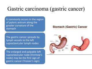 Gastric carcinoma (gastric cancer)
It commonly occurs in the region
of pyloric antrum along the
greater curvature of the
stomach
The gastric cancer spreads by
lymph vessels to the left
supraclavicular lymph nodes
The enlarged and palpable left
supraclavicular node (Virchow’s
node) may be the first sign of
gastric cancer (Troisier’s sign)
 