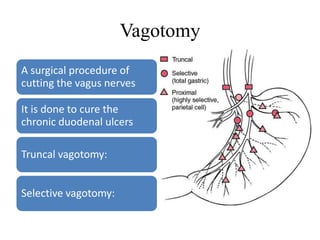 A surgical procedure of
cutting the vagus nerves
It is done to cure the
chronic duodenal ulcers
Truncal vagotomy:
Selective vagotomy:
Vagotomy
 