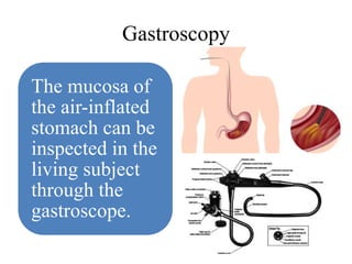 Gastroscopy
The mucosa of
the air-inflated
stomach can be
inspected in the
living subject
through the
gastroscope.
 