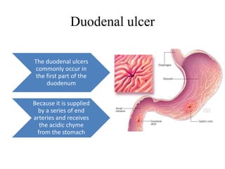 Duodenal ulcer
The duodenal ulcers
commonly occur in
the first part of the
duodenum
Because it is supplied
by a series of end
arteries and receives
the acidic chyme
from the stomach
 