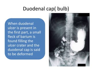 Duodenal cap( bulb)
When duodenal
ulcer is present in
the first part, a small
fleck of barium is
found filling the
ulcer crater and the
duodenal cap is said
to be deformed
 