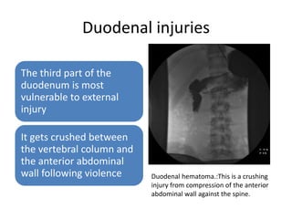 Duodenal injuries
The third part of the
duodenum is most
vulnerable to external
injury
It gets crushed between
the vertebral column and
the anterior abdominal
wall following violence Duodenal hematoma.:This is a crushing
injury from compression of the anterior
abdominal wall against the spine.
 