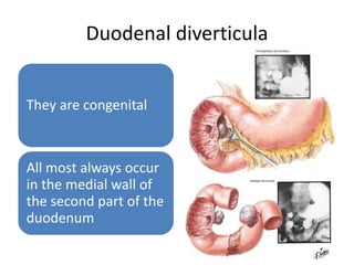 Duodenal diverticula
They are congenital
All most always occur
in the medial wall of
the second part of the
duodenum
 