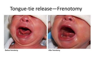 Tongue-tie release—Frenotomy
 