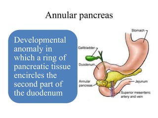 Annular pancreas
Developmental
anomaly in
which a ring of
pancreatic tissue
encircles the
second part of
the duodenum
 