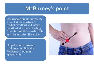 McBurney’s point
It is marked on the surface by
a point at the junction of
medial two-third and lateral
one-third of a line extending
from the umbilicus to the right
anterior superior iliac spine
On palpation maximum
tenderness is elicited at
McBurney’s point in
appendicitis
 
